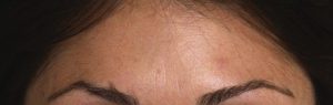 botox front aprés