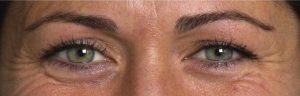 botox pate d'oie